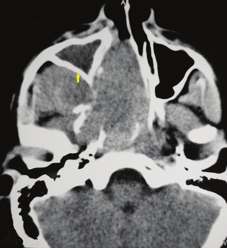 Axial section, contrast-enhanced computed tomography scan shows a large heterodense destructive soft tissue lesion seen in the superior postero-lateral wall of the right nasal cavity, extending into the nasopharynx and adjacent pterygopalatine fossa, right pre-maxillary space causing bowing of the posterior antral wall: The characteristic Holman Miller sign (yellow arrow) with erosion/ destruction of adjacent bones.